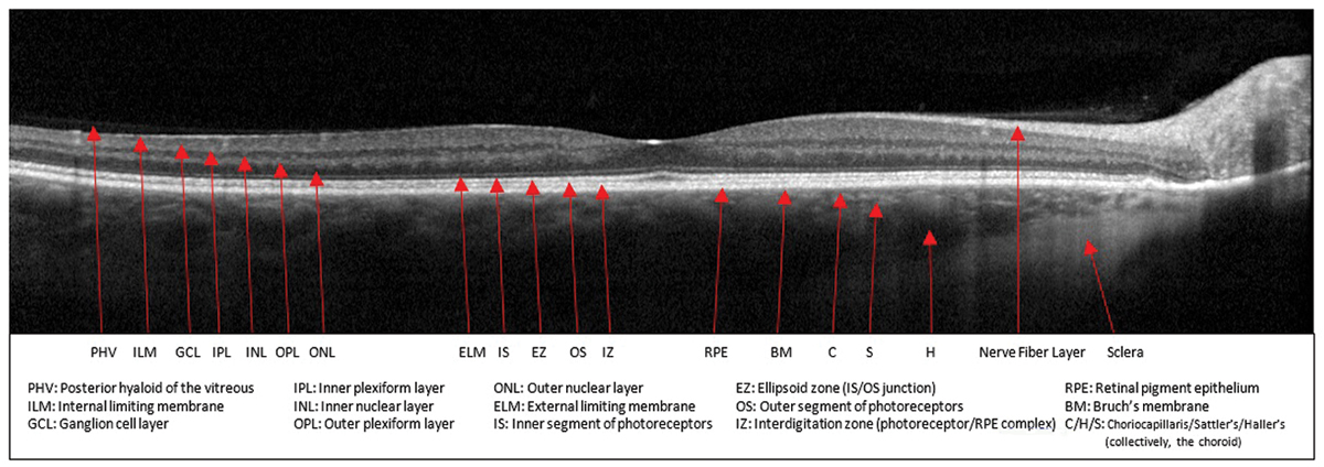 Geographic atrophy causes incorrect automated OCT segmentation in a high proportion of eyes with extensive outer retinal atrophy.