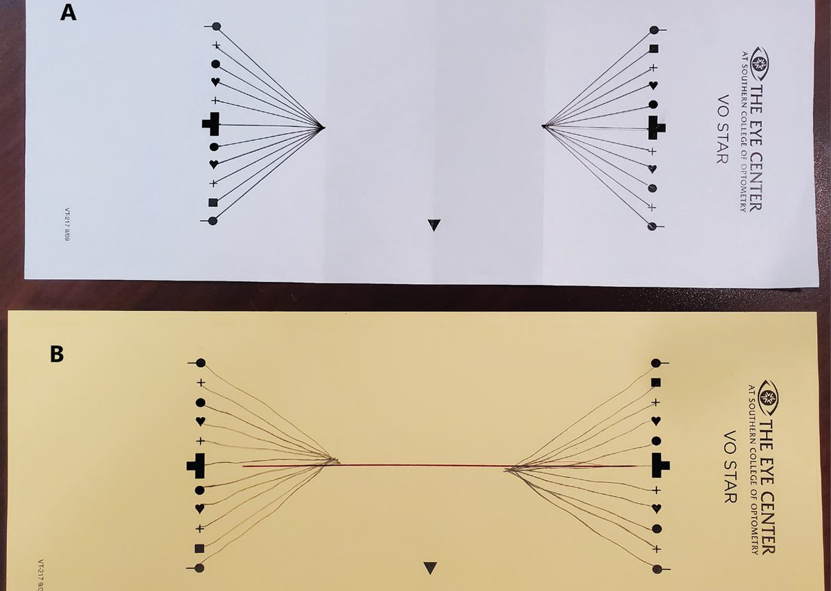 Fig 1. An ideal Van Orden star (A). Note the cleanly formed apices and vertical alignment. Dr. Schnell’s baseline Van Orden star showing vertical misalignment and esophoria (B).