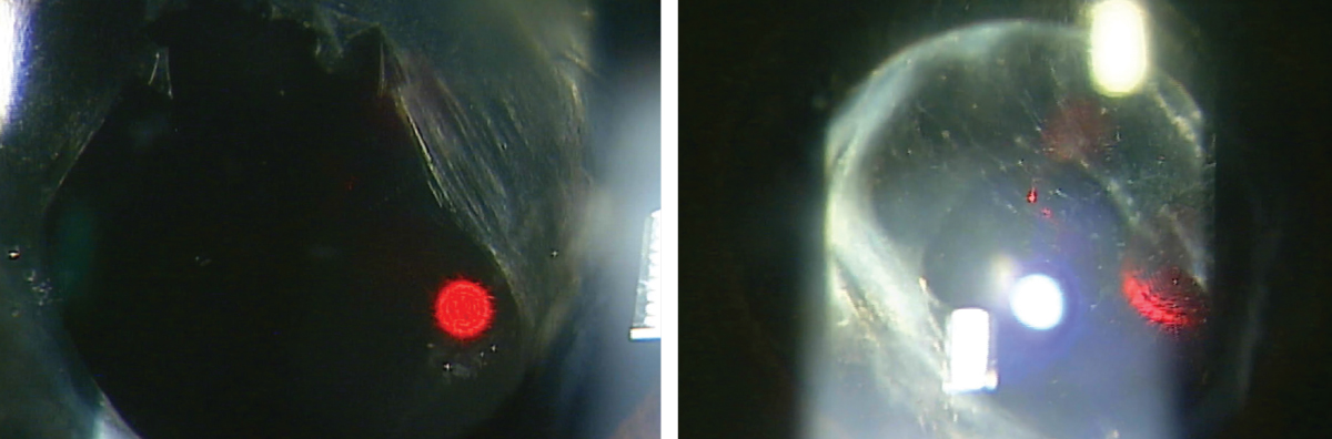 A patient before (left) and after (right) undergoing a YAG posterior capsulotomy. 