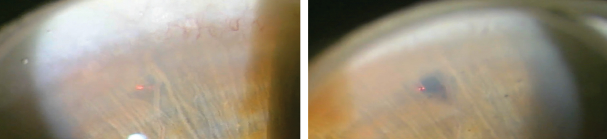 A laser peripheral iridotomy patient before (left) and after (right) the procedure.