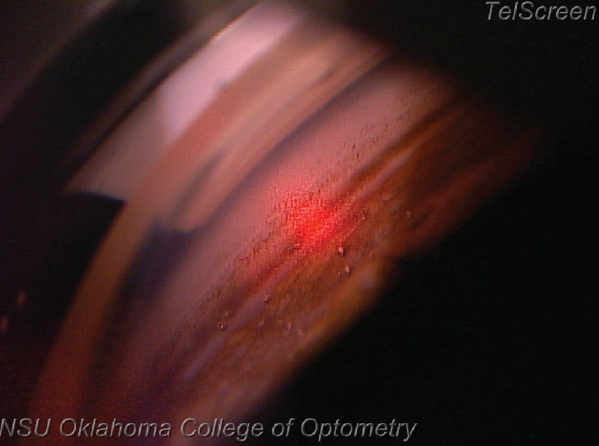 SLT during the procedure. Notice the difference between tissue about to be treated (up and to the right of the red beam) compared to the tissue already treated (down and to the left of the red beam).