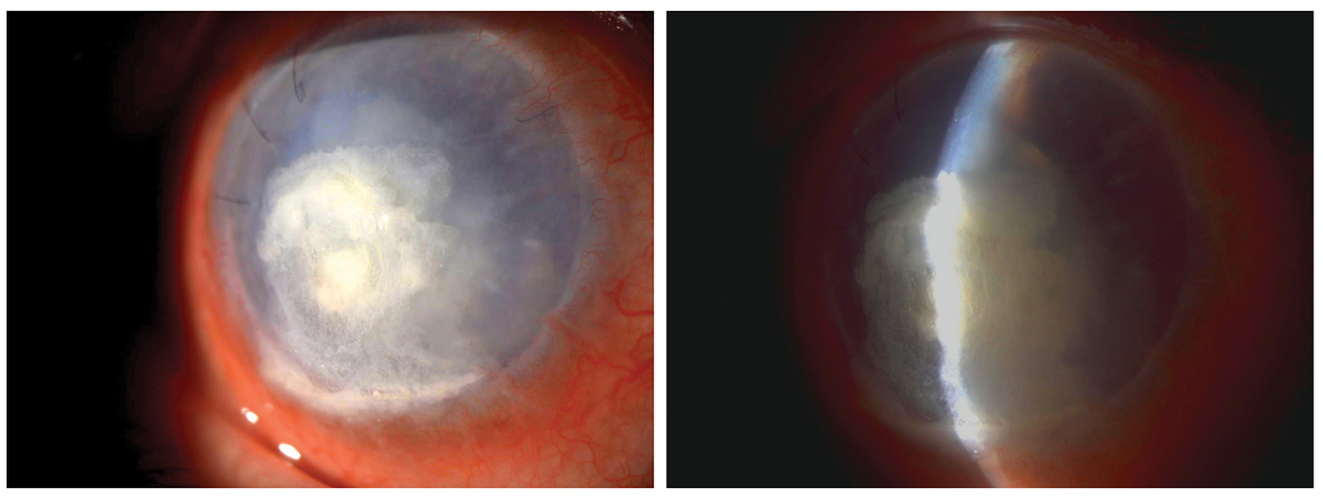Bandage contact lenses are beneficial for corneal protection in this case of corneal perforation.