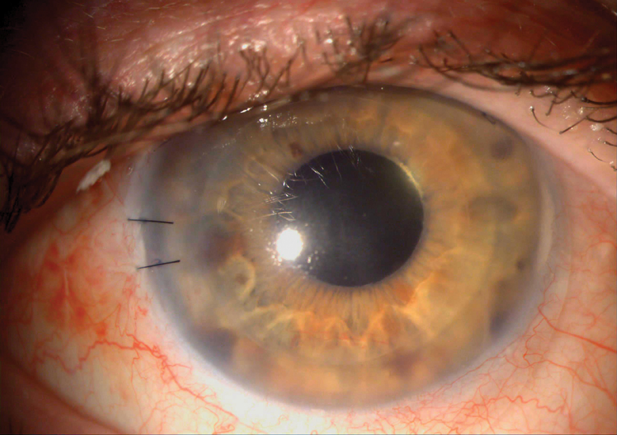 Several studies have demonstrated the utility of BCL wear in maintaining epithelial integrity following penetrating keratoplasty.