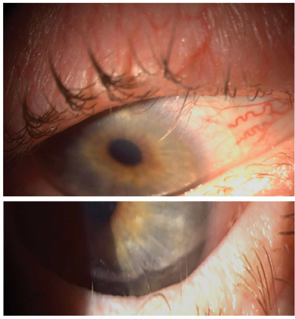 The use of BCLs has also been noted in corneal protection from the ocular adnexa, such as in the case of trichiasis.
