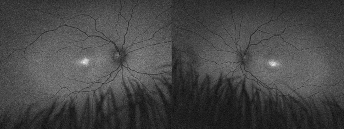 Fundus autofluorescence imaging of a child with achromatopsia confirmed with genetic testing. The diagnosis helped provide the family with assurance of likely stable vision and appropriate recommendations for school, including prescribed low vision aids and discontinuation of Braille training. Genetic test results were also used to refer the patient for an achromatopsia gene therapy clinical trial.