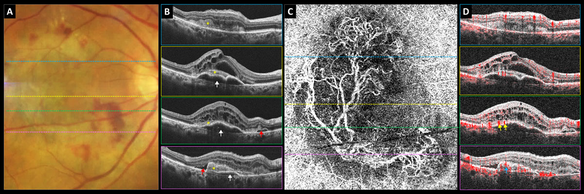 Fig. 7. Predominately type 2 neovascular exudative AMD: (A) color photograph, (B) structural OCT, (C) 6mm OCT-A outer retina choriocapillaris en-face display and (D) OCT-A B-scan overlay. White arrows point to PED, yellow asterisk shows subretinal neovascular membrane, red arrows point to subretinal fluid, yellow arrows point to subretinal feeder vessels and blue arrow points to subretinal neovascular membrane.
