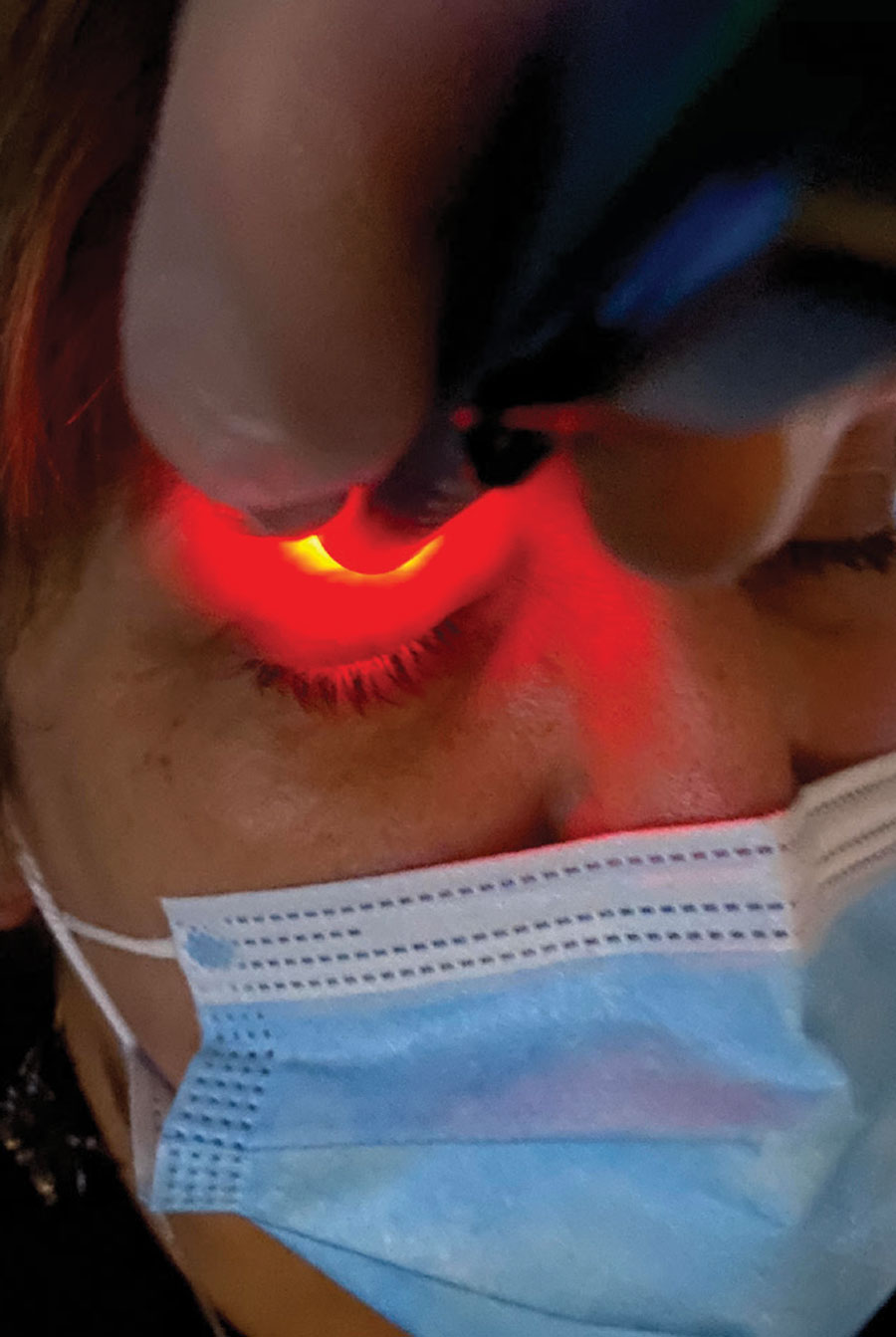 The Korb-Blackie light test can detect ILS by determining if the patient’s closed lids are protecting the ocular surface and preventing evaporation during sleep.