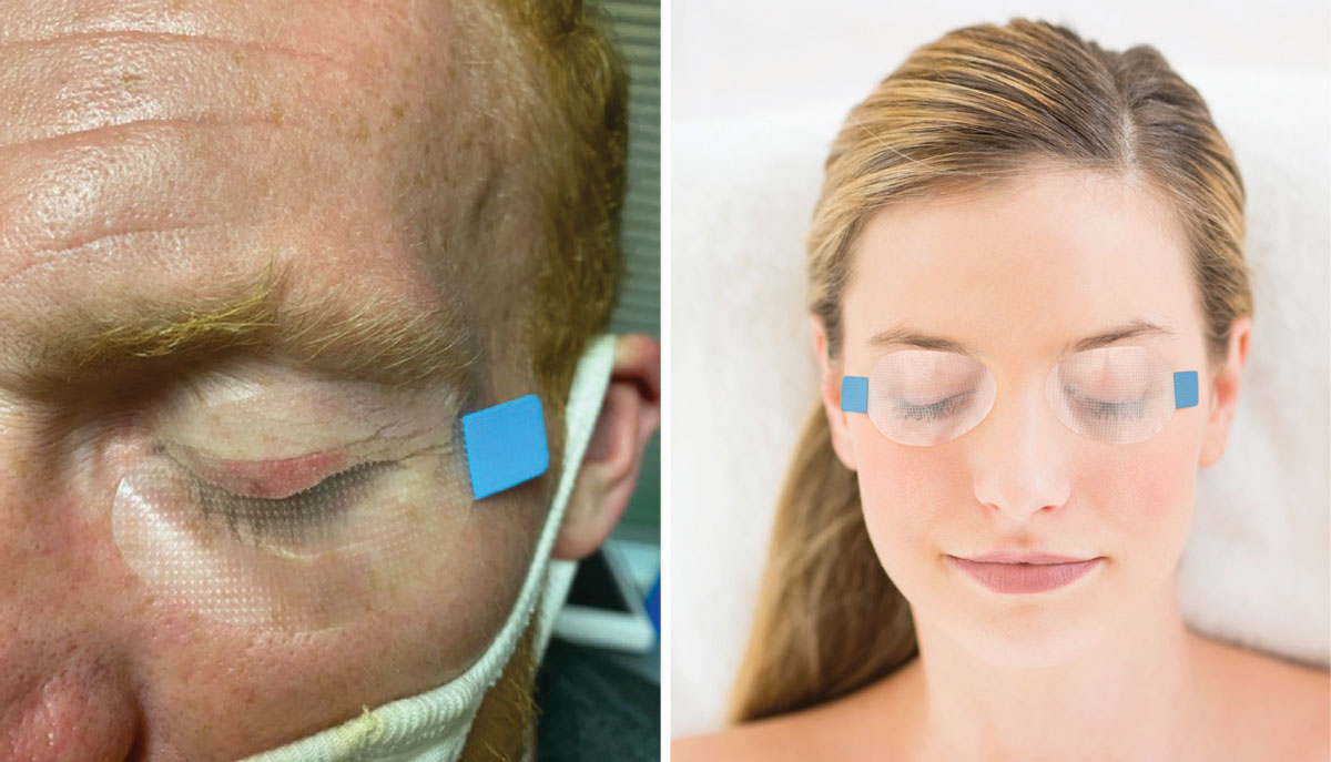 SleepTite being used post-amniotic membrane placement on the left. Most patients should begin by closing one eye each night, although some will be able to apply it bilaterally in time, as shown on the right.