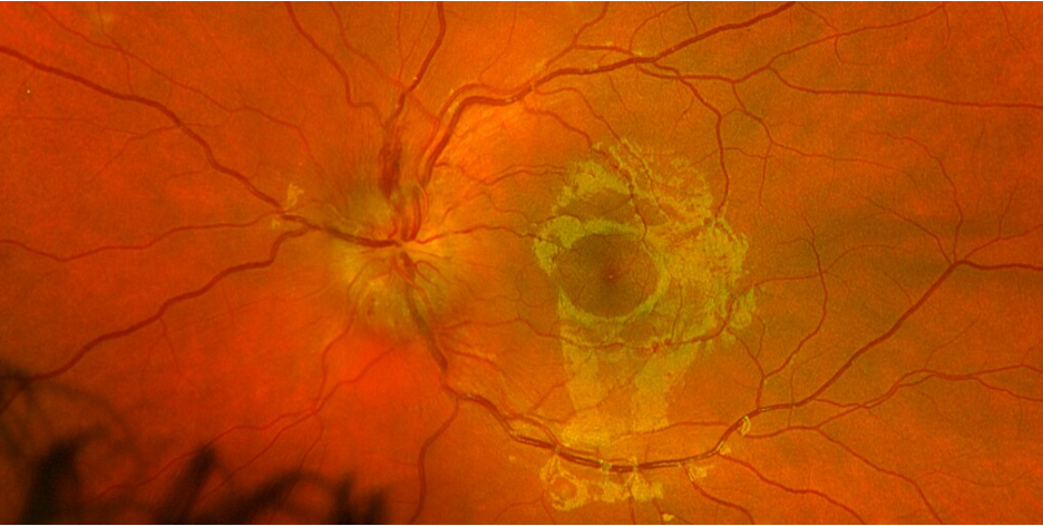 Figure 2. Left eye with 2-3+ optic nerve head edema with disc hemorrhages and no cystoid macular edema.