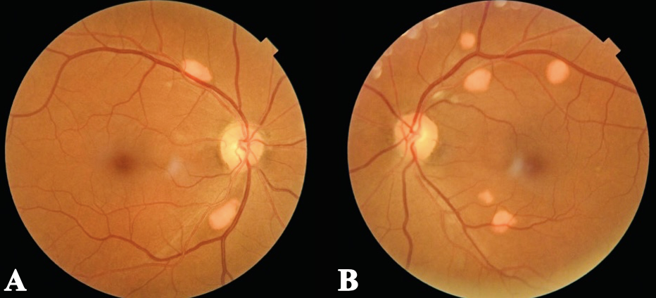 Figure 1. Fundus photos of both eyes show scattered elevated, orange-yellow lesions with distinct borders, located along the superotemporal and inferotemporal retinal vascular arcades within the posterior pole.