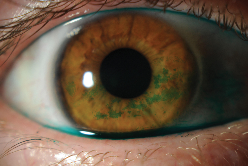 Slit lamp photo depicting lissamine green staining on cornea.
