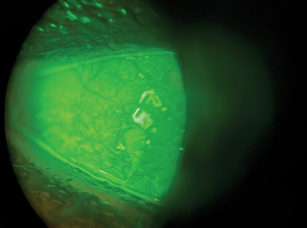 Fluorescein staining seen in dry eye.