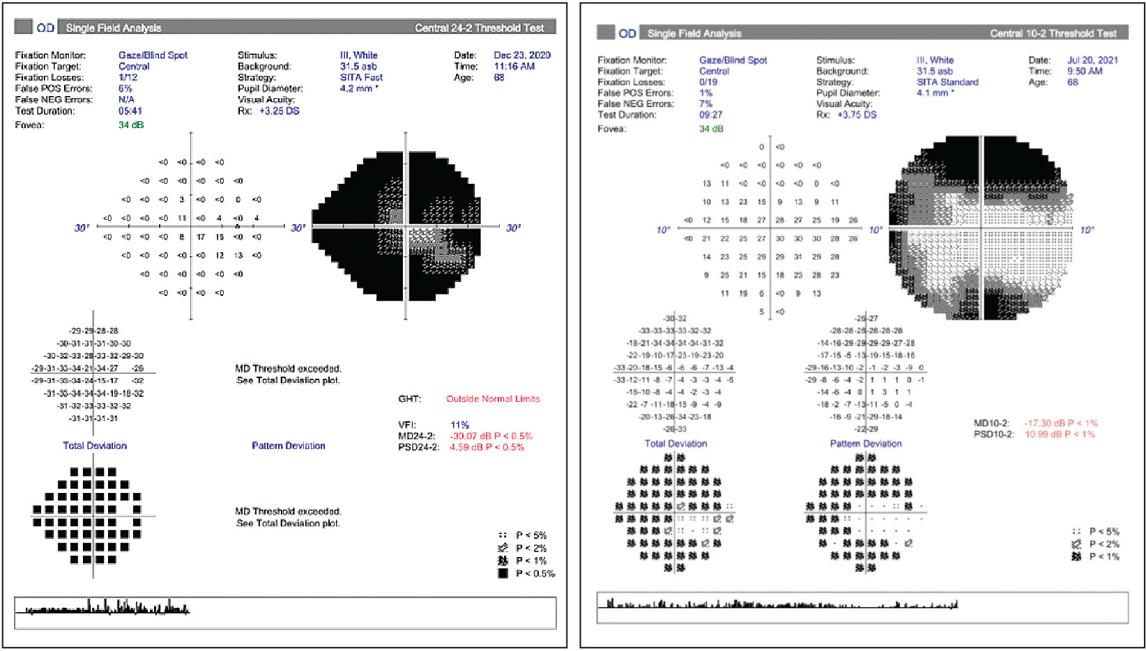 Left: Small central island in advanced glaucoma. Right: The same patient was assessed with 10-2 testing to allow for more points in the remaining central island to be monitored.