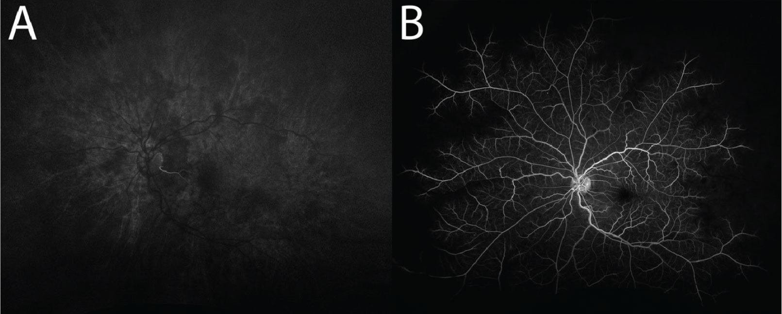 (A) Delayed first appearance of choroidal flush, captured at 26 seconds. Note the filling of a small cilioretinal artery, which is supplied by the choroid. (B) Delayed and incomplete filling of the retinal arteries, captured at 69 seconds. There are also a few microaneurysms present.