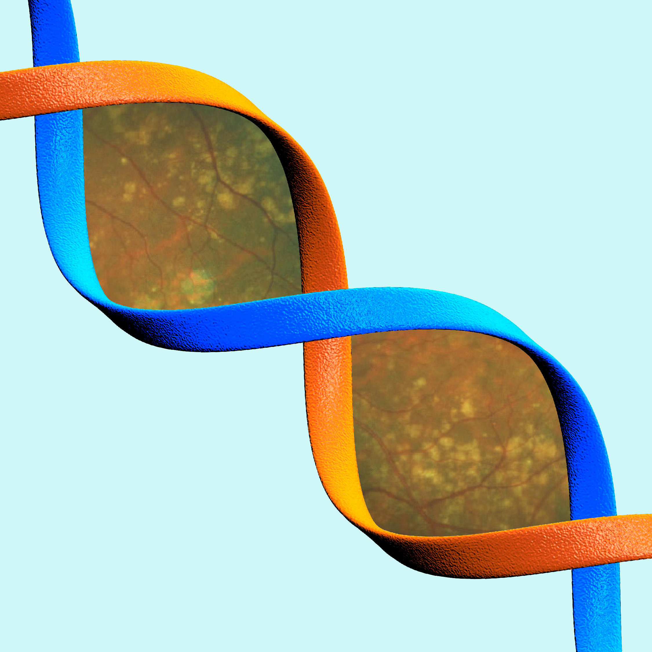 Drusen is likely a genetic marker for AMD, study finds.