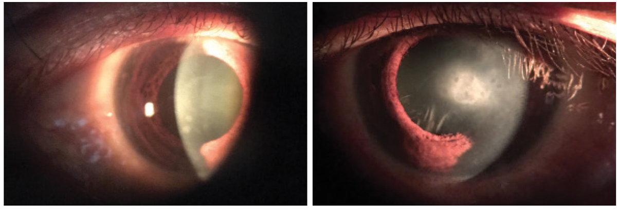 The anterior segment findings in our patient, OD (left) and OS (right). Do these presentations lead to any possible diagnoses to consider?