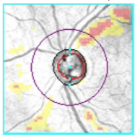 Structural changes in the optic nerve rim can signify glaucomatous progression.