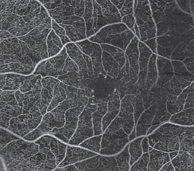 Diabetes patients in this study had FAZ enlargement, reduced vascular density in the macular area and significant deviations of FAZ shape parameters compared with healthy controls.