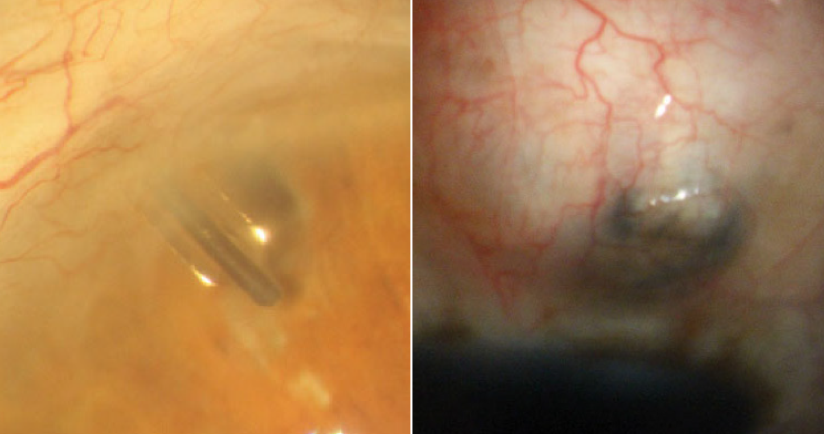 Tube shunt implantation and trabeculectomy are both viable options for surgical treatment of glaucoma.