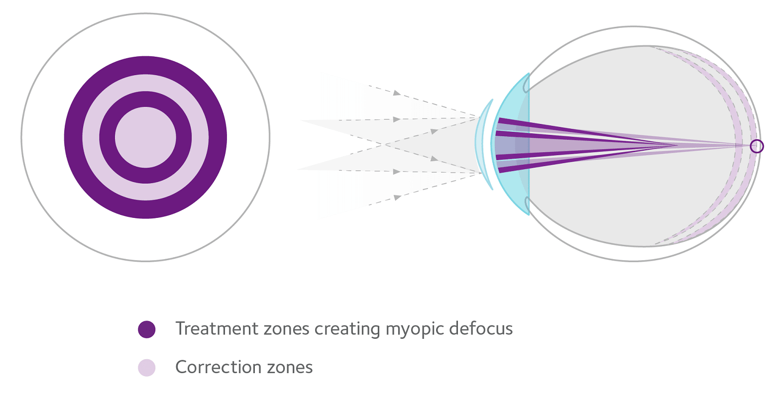 Choroidal thickness may be a predictor of the efficacy of MiSight lenses for treating myopia.