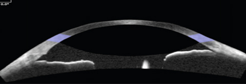 A recent provided a practical way to evaluate swept source OCT data by focusing on angle parameters measured 750µm from the scleral spur and at the 0° and 270° axes.