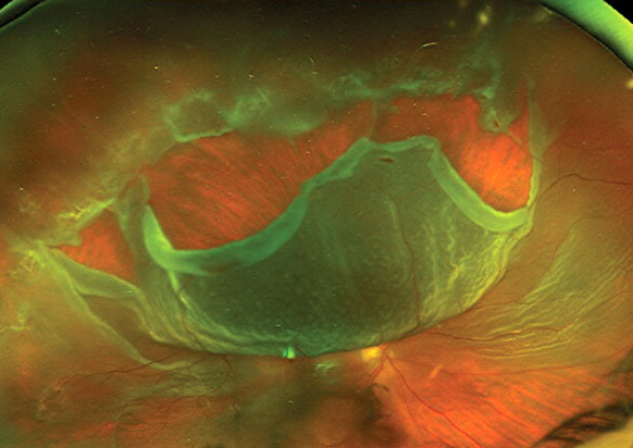 Visual outcomes in macula-off RRD repair within three days from symptom onset were superior to those from repair between four and seven days. For macula-involving RRD repair, initiating surgery within the first 24 hours showed the most superior outcomes. 