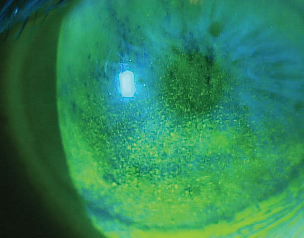 Switching to a preservative-free drop seems to cause less damage to the ocular surface in many glaucoma patients and helps prevent adverse events such as BAK toxicity, as shown here.
