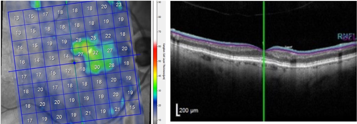Structural damage seen on OCT is more representative of glaucoma staging systems than perimetry.