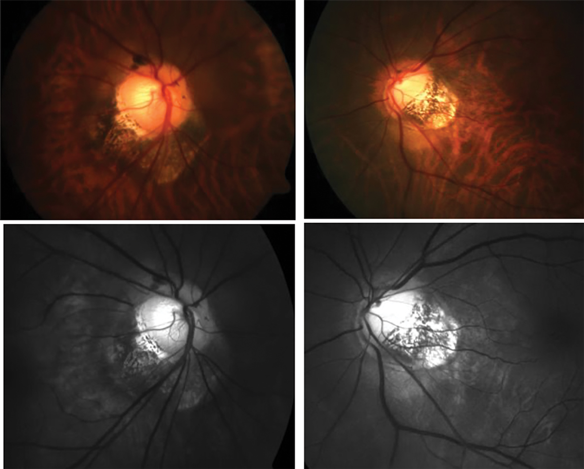 Having a tilted disc or high myopia may increase the likelihood of having peripapillary hyperreflective ovoid mass-like structures, study finds. 