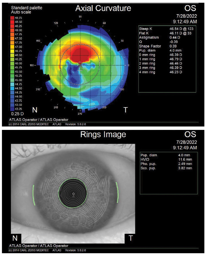 Fig. 1. Check the cornea for any irregularities before moving forward with cataract patients.