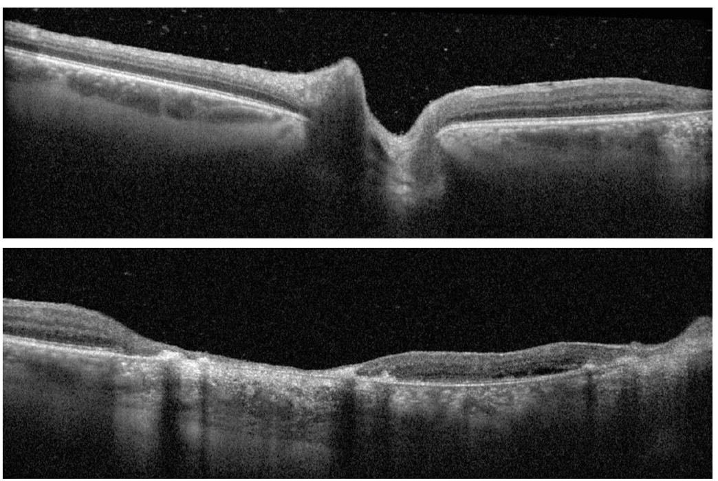 Figs. 3 and 4. Spectralis OCT of the left optic nerve and left macula.