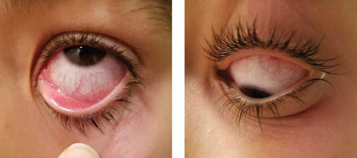 pink eye treatment antibiotic