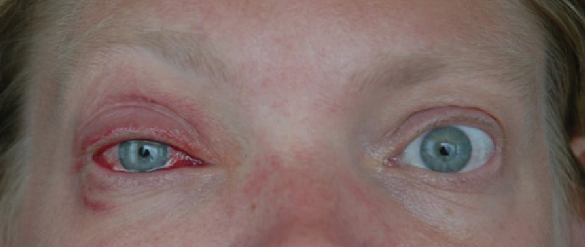 8 Common Myths About Pink Eye