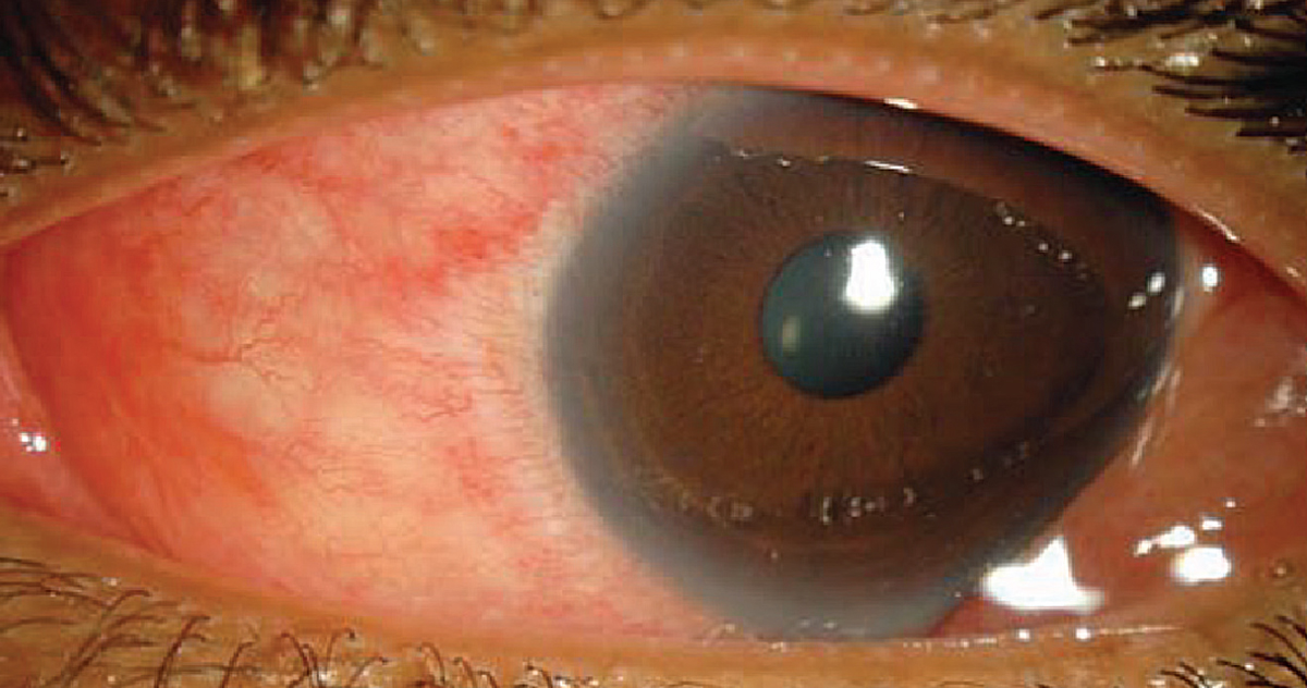 Examples of the variability of the red eye phenomenon. Golden eyes
