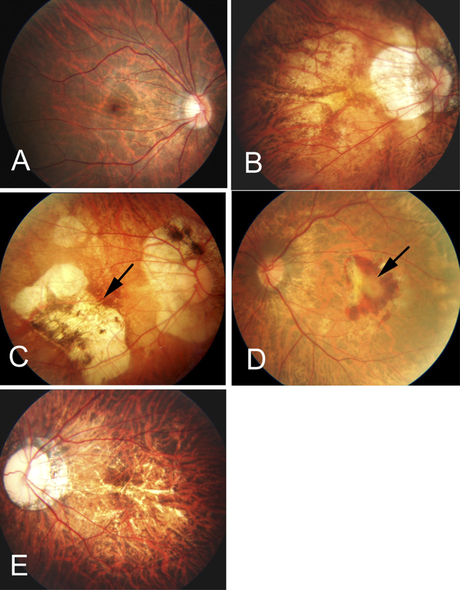 A macular hemorrhage and fibrovascular membrane (arrow) in a 67-year-old, 10.50D myopic woman.