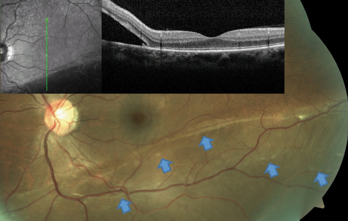 This RRD patient’s OCT image, layered over a fundus photograph, shows partial involvement of the macula, even though the patient is totally asymptomatic from this slowly progressive inferior RD. Blue arrows point to a number of subretinal bands and partial demarcation lines, a testament to the chronicity of the condition.