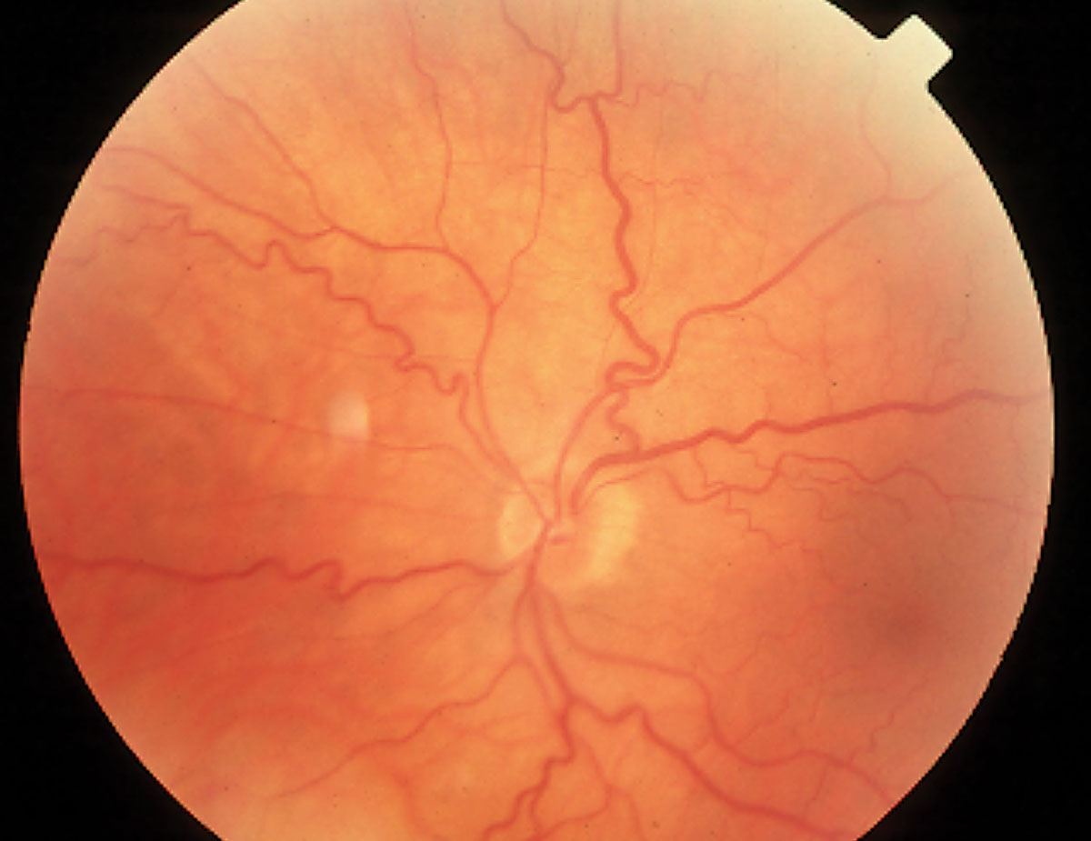 Several alleles associated with retinal vessel tortuosity suggest a common genetic architecture of this trait with cardiovascular diseases and metabolic syndrome. 