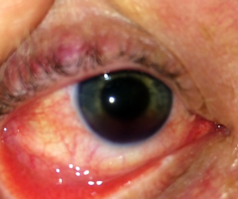 Hospital-based ophthalmology ER consultations reached a peak in September and were lowest in April, study finds. This patient was struck in the eye with a wiffleball while playing with his son.