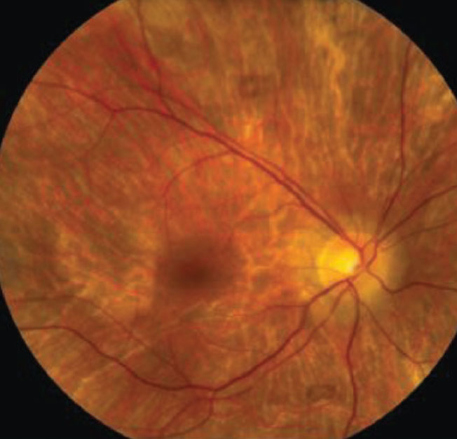 Clinical signs and symptoms of thioridazine toxicity include decreased visual acuity, visual field defects and retinal pigment epithelial disturbances. There is selective uptake of thioridazine in pigmented uveal tissue and the retinal pigment epithelium, which results in toxicity.