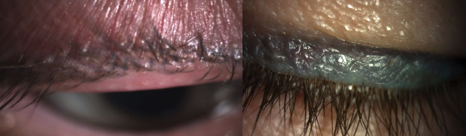 Pigment fade (left) and spread (right), with the tattooed eyeliner extending upward further than the thin line originally applied, of permanent makeup. Both patients have dry eye with MGD.