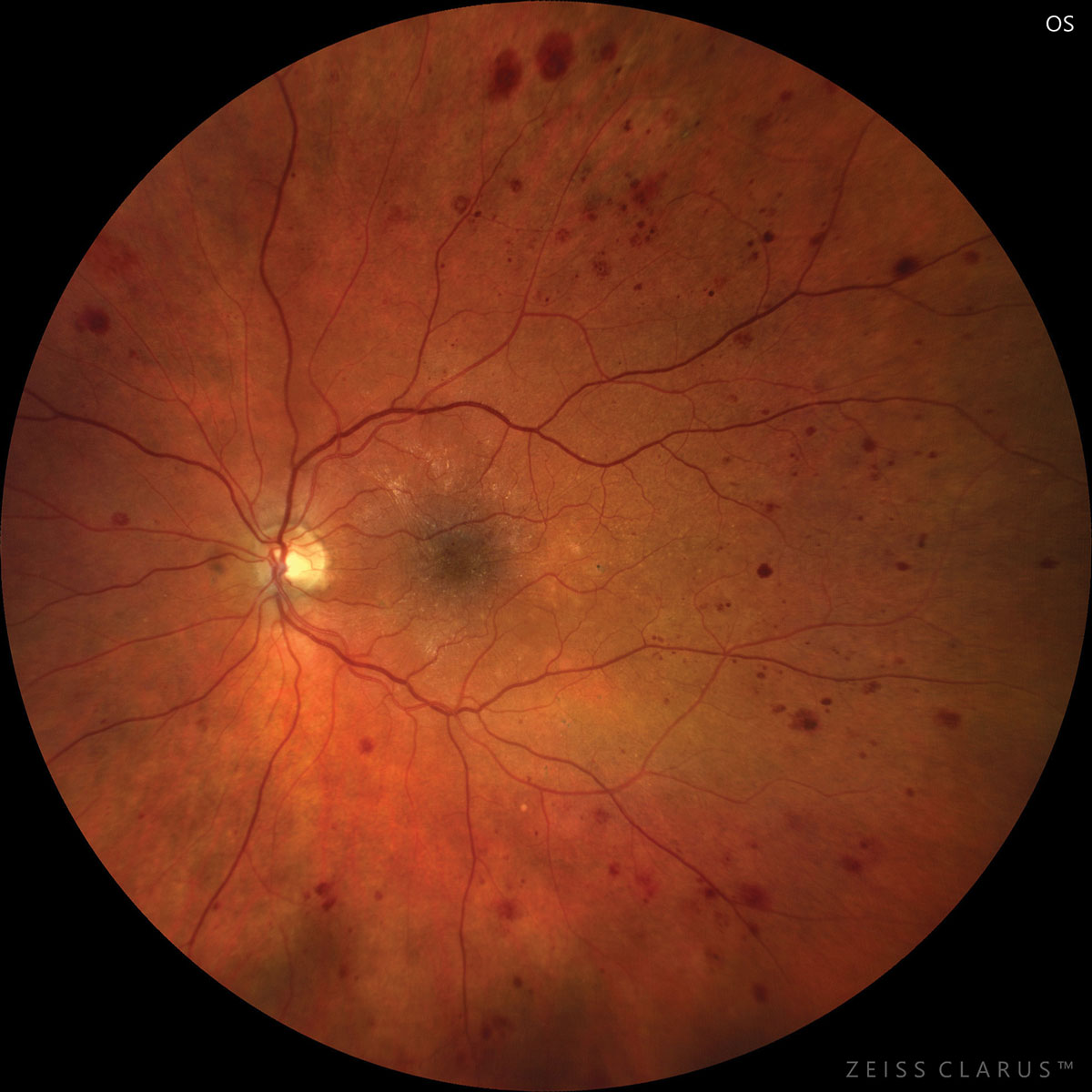 Diabetic retinopathy represents an independent risk factor for stroke, suggesting microvascular pathology plays a role.