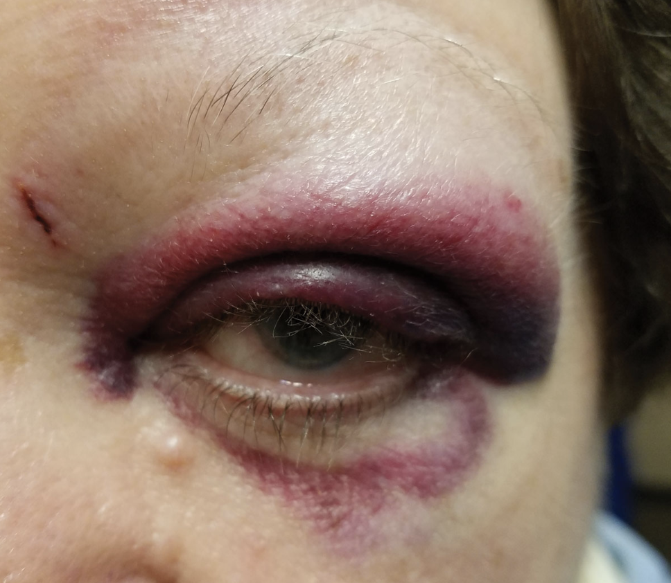 While most of the patients who sustained domestic violence-related ocular injuries were young women with less privileged SES, older adults and patients with Medicare insurance were significantly more likely to be hospitalized.