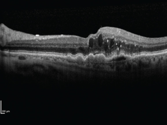 OCT monitoring showed earlier nAMD diagnosis in fellow eyes and could improve patient outcomes.