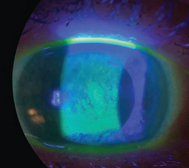 An example of dry eye compromising the ocular surface, seen with sodium fluorescein staining.