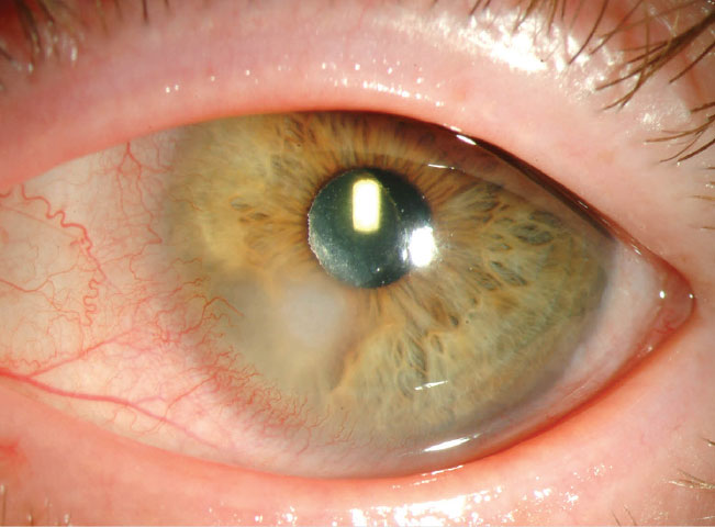 An example of a Pseudomonas infection, which can be far more commonly found in nonadherent contact lens patients.