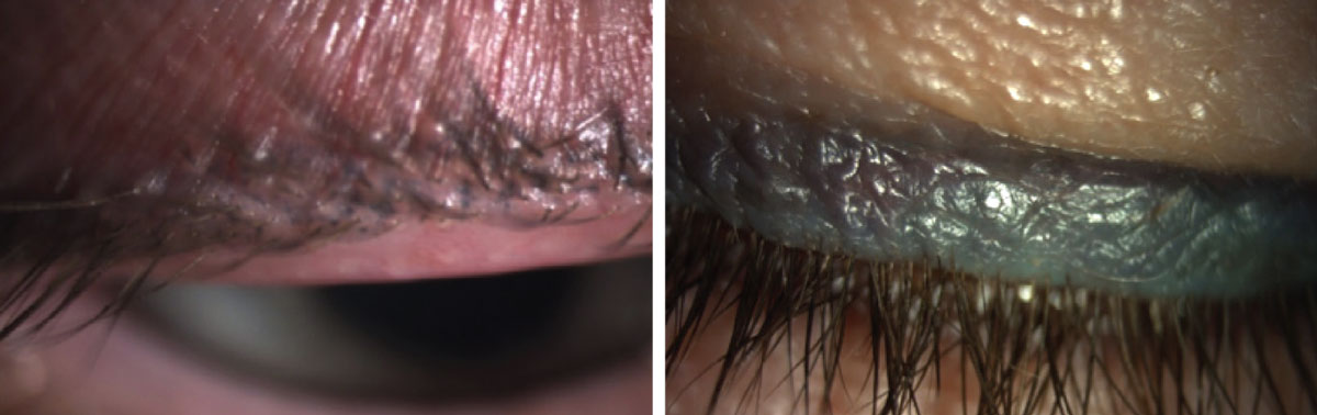 Inappropriate use of permanent makeup. Both patients have dry eye with MGD.