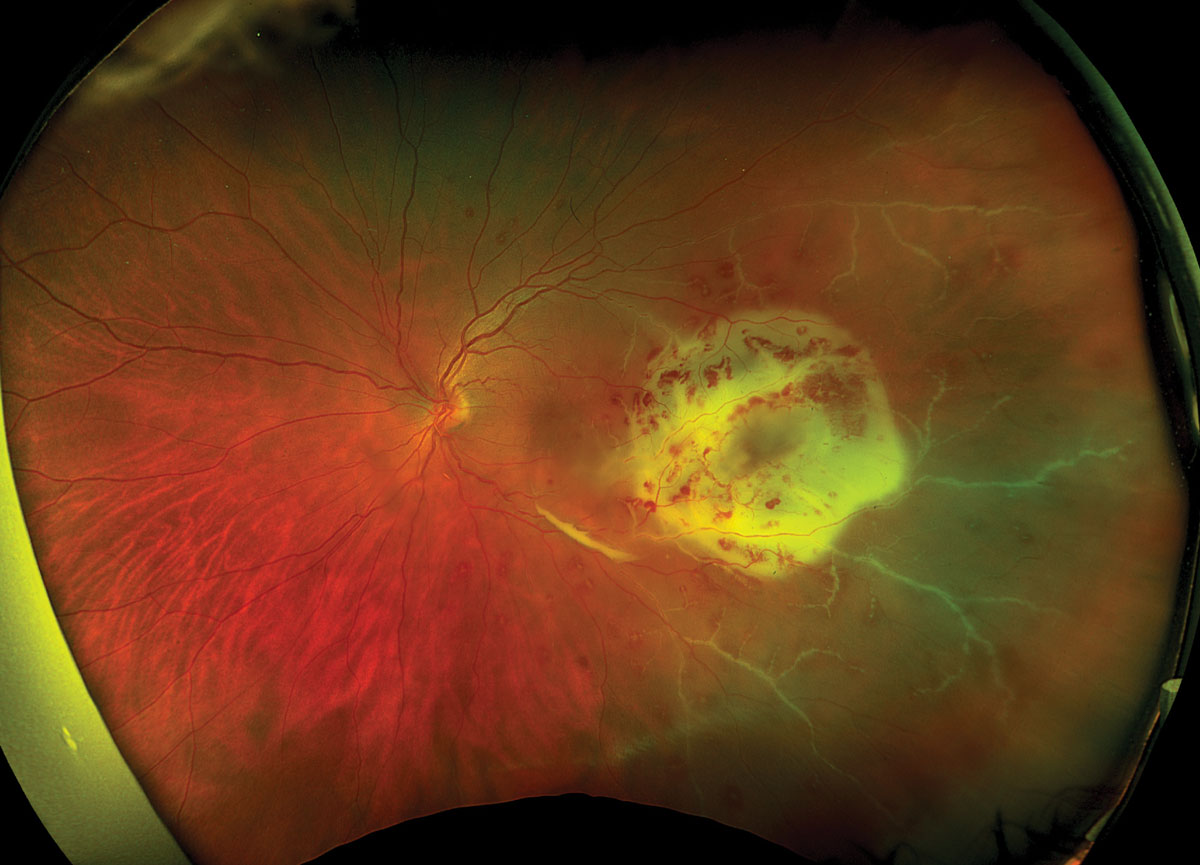 Fig. 1. Optos widefield fundus photography of the left eye at presentation.