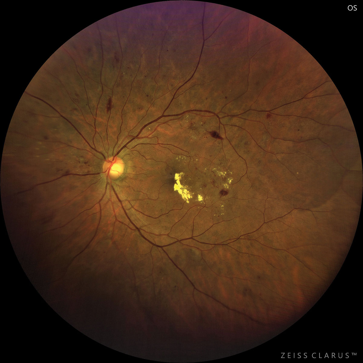 In proliferative disease, white blood cells can enter the retina when the blood-retinal barrier is compromised via neovascularization. This may lead to an increase in white blood cells entering the eye and a decrease in white blood cells in circulation.