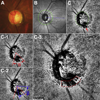 Patients with higher mean rates of change in the choroidal microvasculature dropout area may be at an increased risk of accelerated vision loss. 
