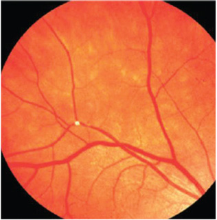 Overall health burden and resulting impact on cardiometabolic health may be underlying contributors to an increased risk of retinal emboli in low-income individuals. 